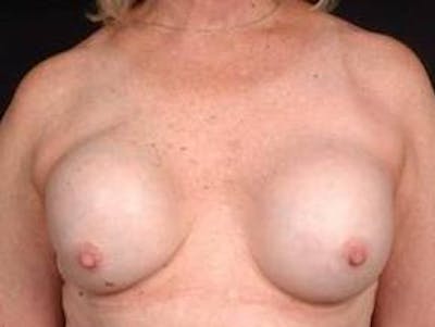 Reconstructive Breast Revision Before & After Gallery - Patient 343310 - Image 1