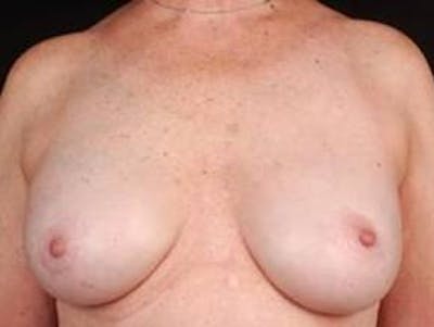 Reconstructive Breast Revision Before & After Gallery - Patient 343310 - Image 2