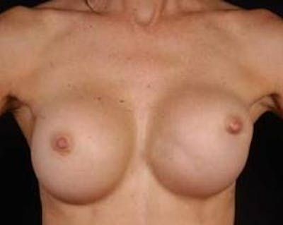 Reconstructive Breast Revision Before & After Gallery - Patient 128326 - Image 1