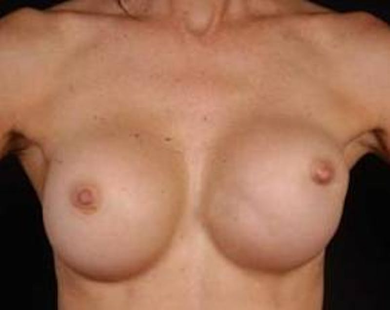 Reconstructive Breast Revision Before & After Gallery - Patient 128326 - Image 1