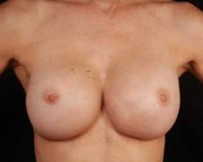 Reconstructive Breast Revision Before & After Gallery - Patient 128326 - Image 2
