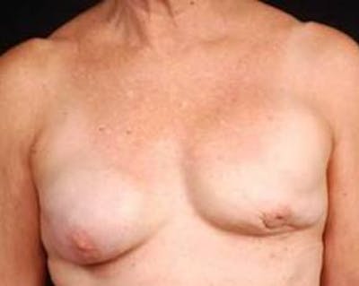 Reconstructive Breast Revision Before & After Gallery - Patient 164655 - Image 1