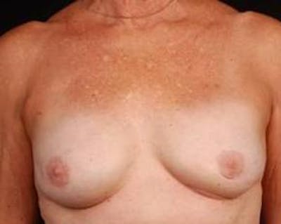 Reconstructive Breast Revision Before & After Gallery - Patient 164655 - Image 2