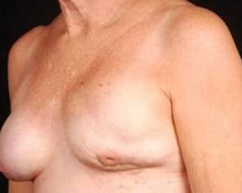 Reconstructive Breast Revision Before & After Gallery - Patient 164655 - Image 3