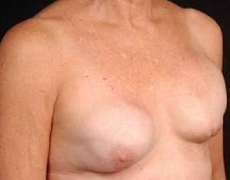 Reconstructive Breast Revision Before & After Gallery - Patient 164655 - Image 5