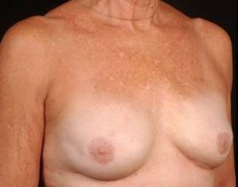 Reconstructive Breast Revision Before & After Gallery - Patient 164655 - Image 6