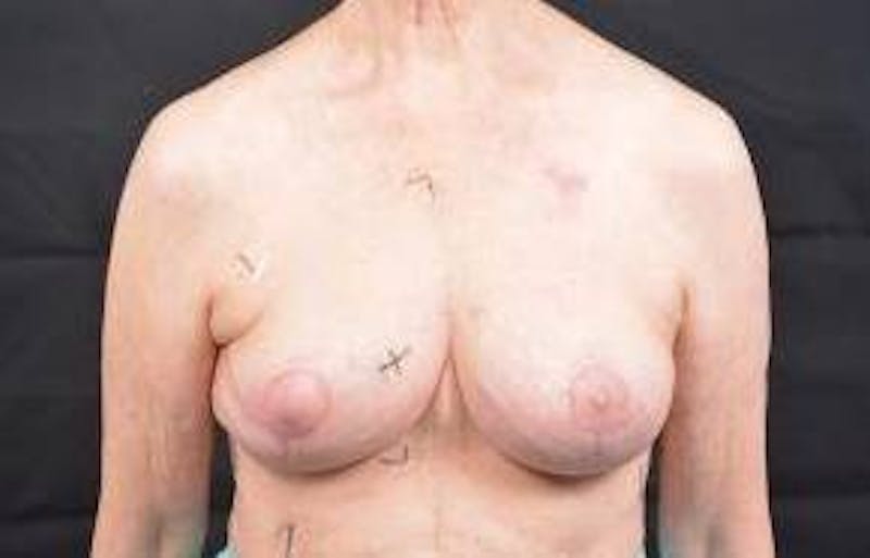 Oncoplastic Reconstruction Before & After Gallery - Patient 248604 - Image 1