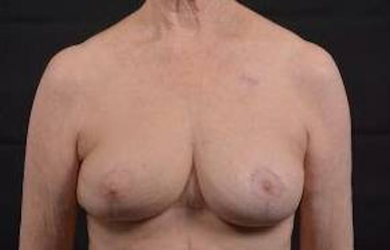 Oncoplastic Reconstruction Before & After Gallery - Patient 248604 - Image 2