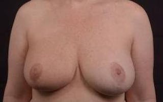 Oncoplastic Reconstruction Before & After Gallery - Patient 475411 - Image 2