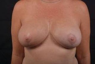 Oncoplastic Reconstruction Before & After Gallery - Patient 108736 - Image 2