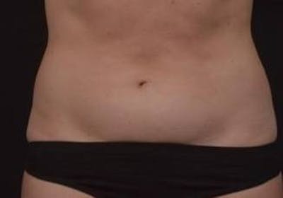 Brazillian Butt Lift Before & After Gallery - Patient 588091 - Image 1
