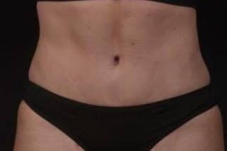 Brazillian Butt Lift Before & After Gallery - Patient 588091 - Image 2