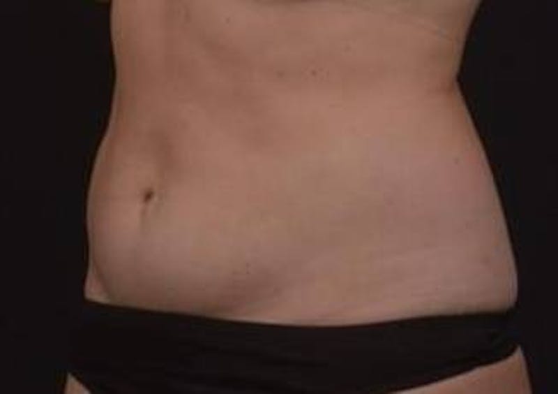 Brazillian Butt Lift Before & After Gallery - Patient 588091 - Image 5