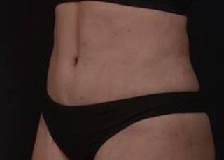 Brazillian Butt Lift Before & After Gallery - Patient 588091 - Image 6