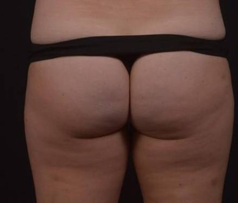 Brazillian Butt Lift Before & After Gallery - Patient 588091 - Image 11