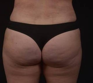 Brazillian Butt Lift Before & After Gallery - Patient 588091 - Image 12