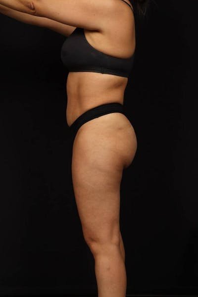 Brazillian Butt Lift Before & After Gallery - Patient 342295 - Image 1