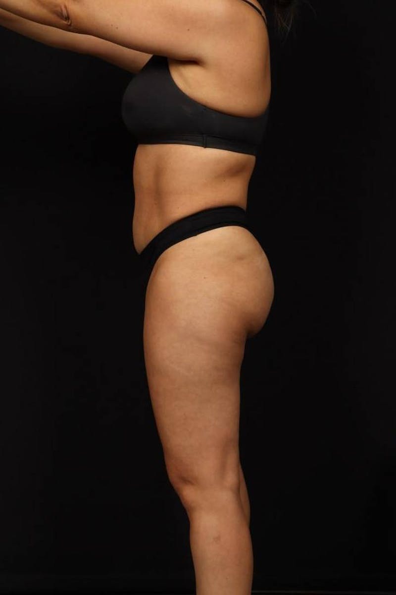 Brazillian Butt Lift Before & After Gallery - Patient 342295 - Image 1
