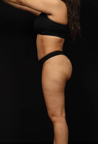 Brazillian Butt Lift Before & After Gallery - Patient 342295 - Image 2