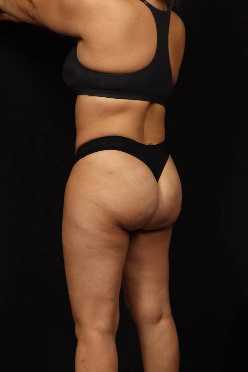 Brazillian Butt Lift Before & After Gallery - Patient 342295 - Image 3