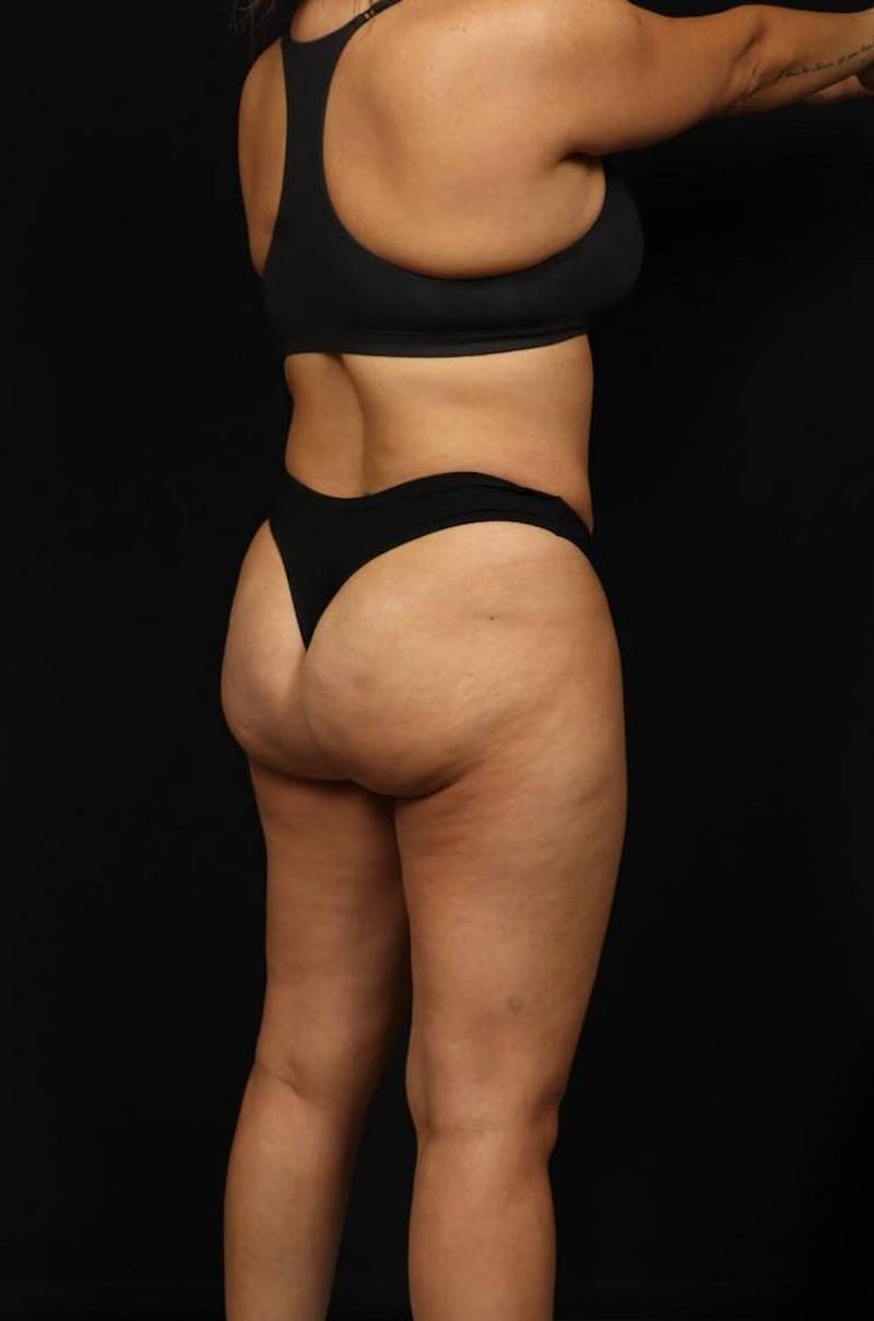 Brazillian Butt Lift Before & After Gallery - Patient 342295 - Image 7