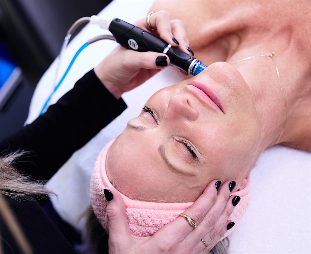 Woman receiving microneedling treatment