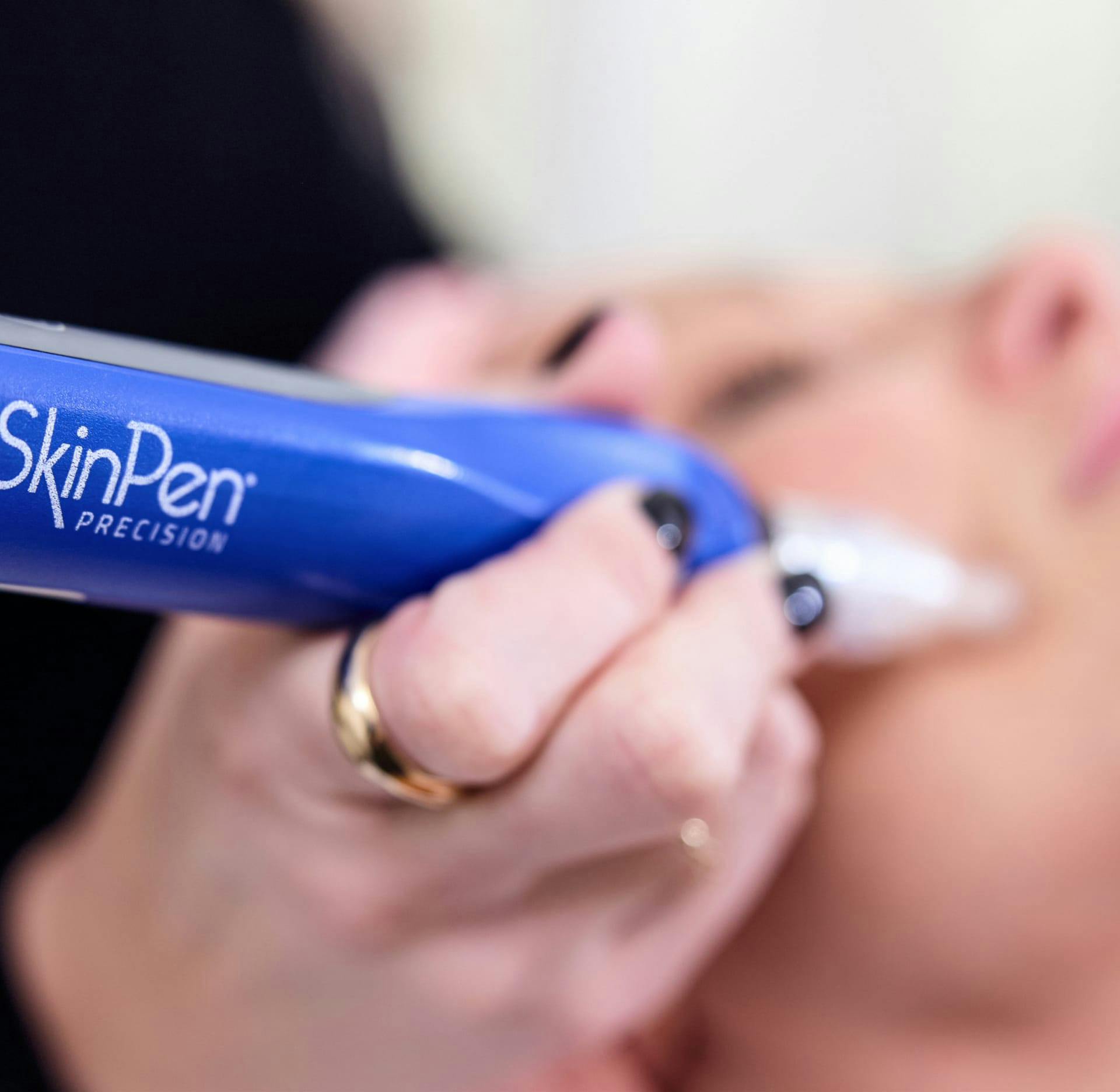 Woman getting a skinpen treatment