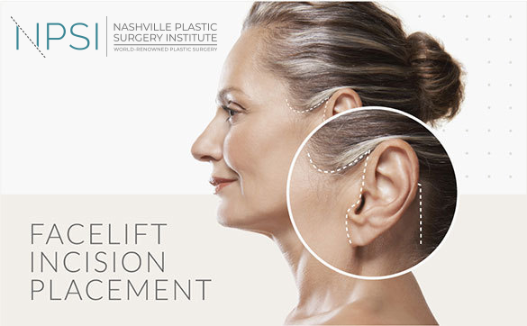 facelift insicion infographic