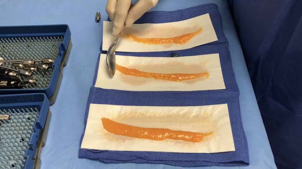 fat grafting procedure