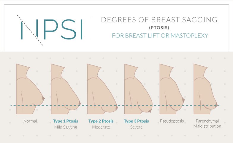 breast sagging inforgraphic