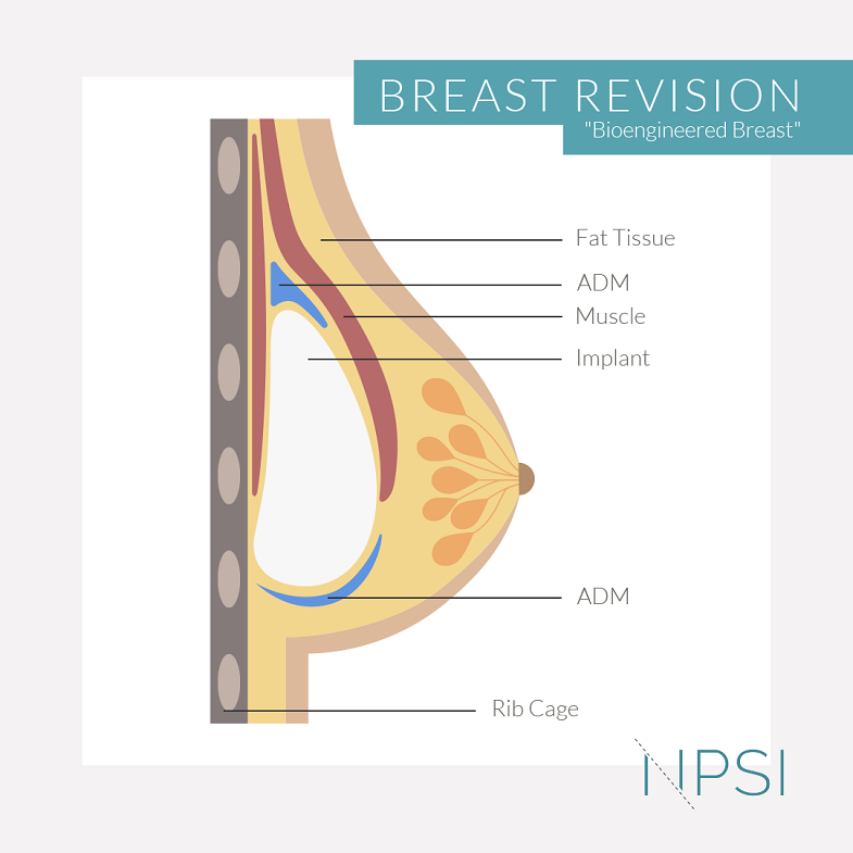 breast revision bioengeneered breast infographic