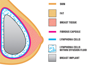 breast implant infographic