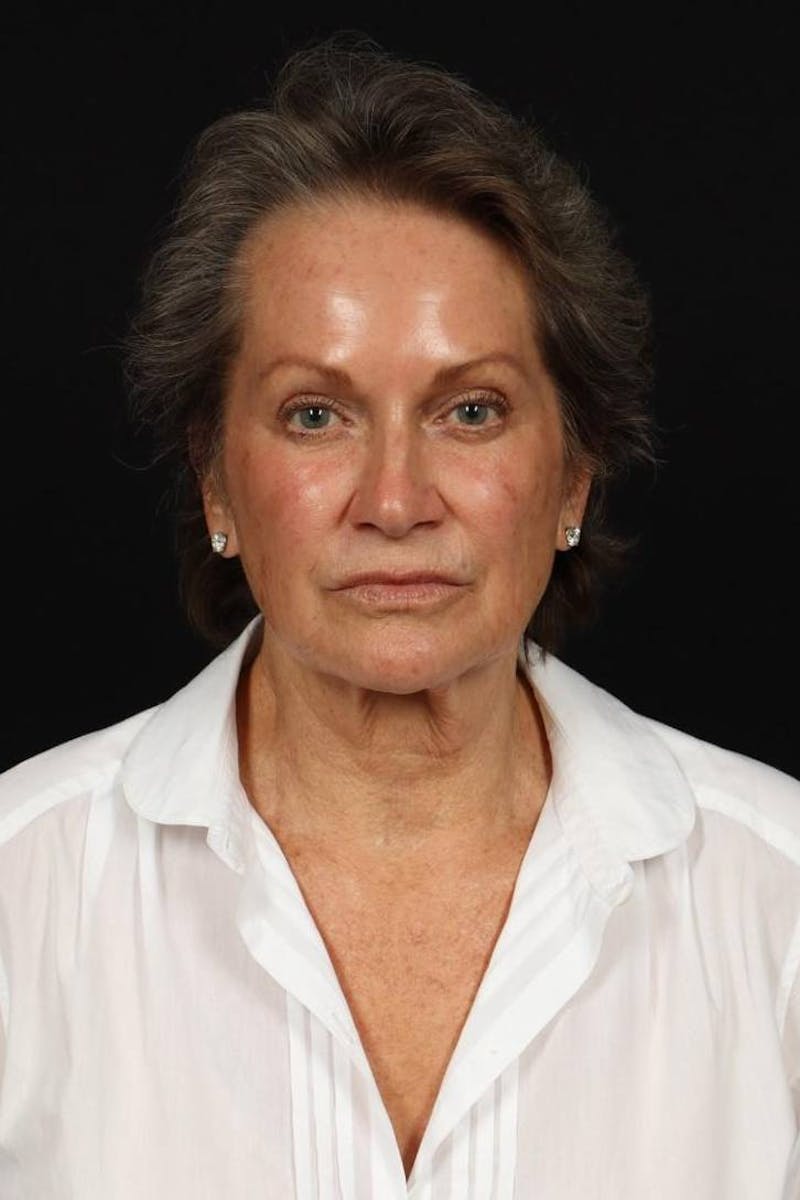 Facelift Before & After Gallery - Patient 241060 - Image 1