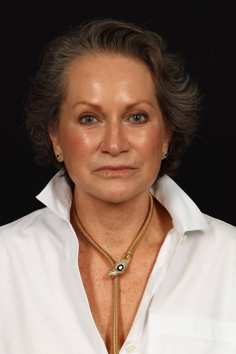 Facelift Before & After Gallery - Patient 241060 - Image 2