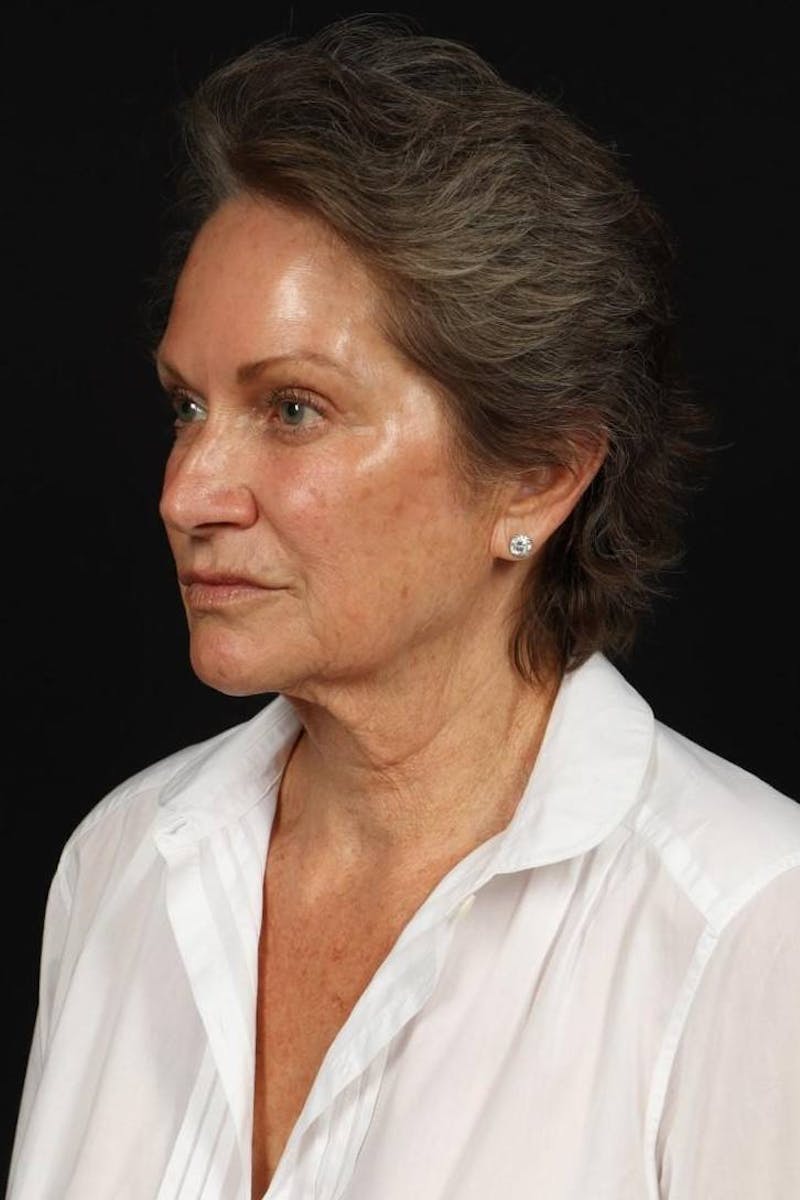 Facelift Before & After Gallery - Patient 241060 - Image 3