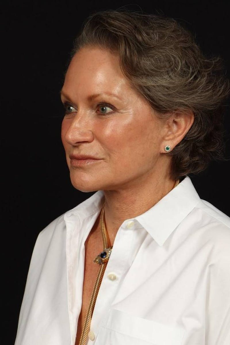 Facelift Before & After Gallery - Patient 241060 - Image 4