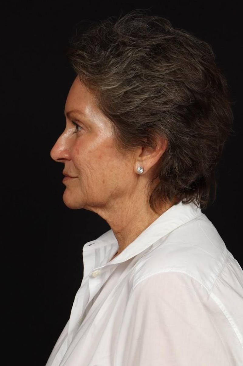Facelift Before & After Gallery - Patient 241060 - Image 5