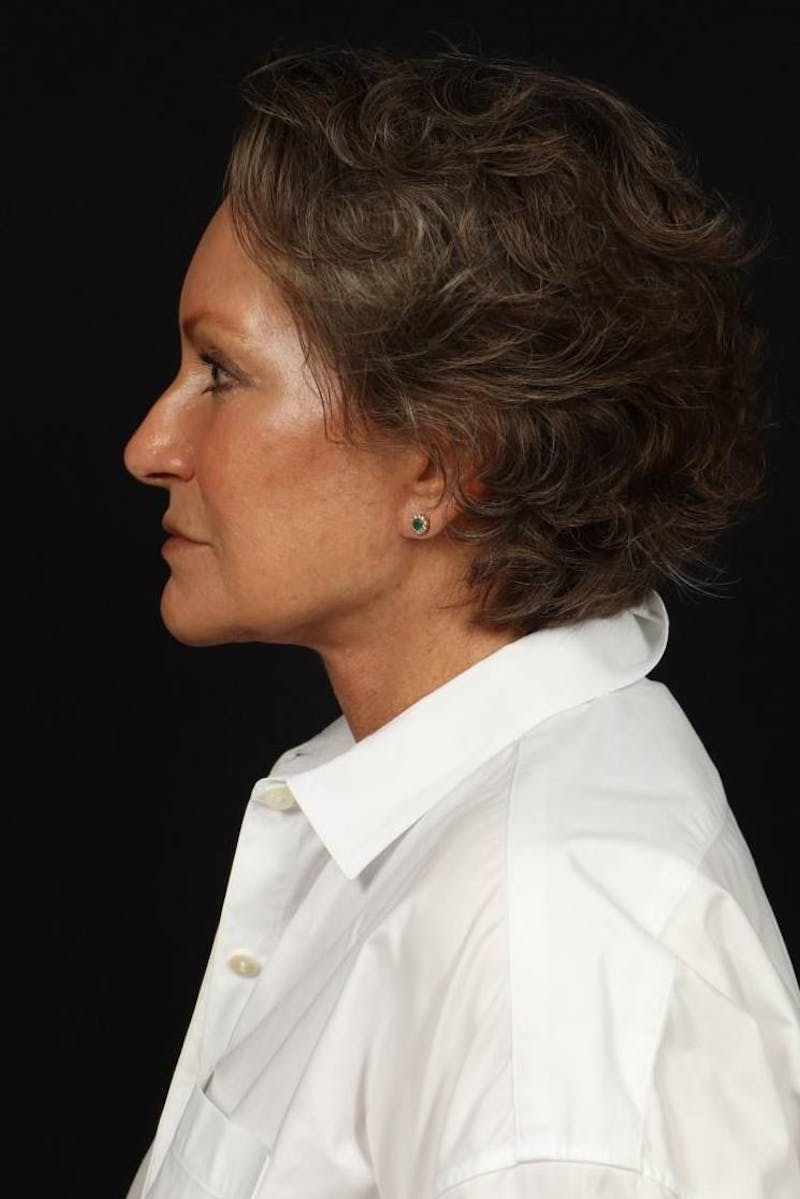 Facelift Before & After Gallery - Patient 241060 - Image 6