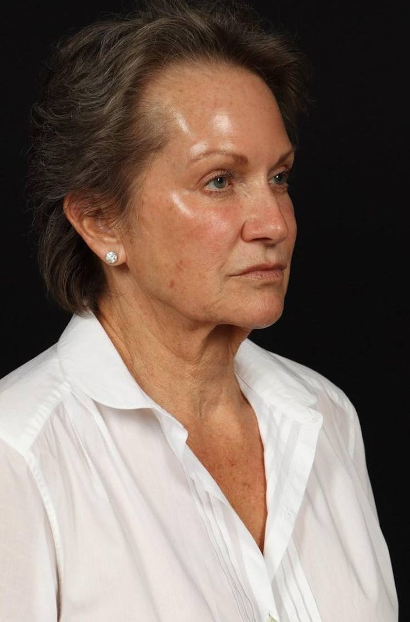Facelift Before & After Gallery - Patient 241060 - Image 7