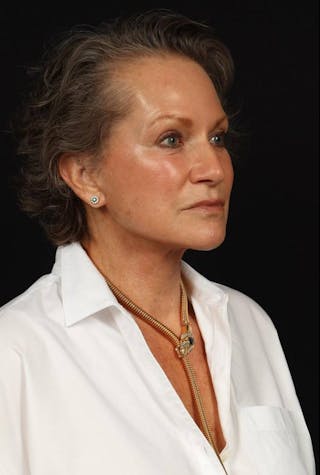 Facelift Before & After Gallery - Patient 241060 - Image 8