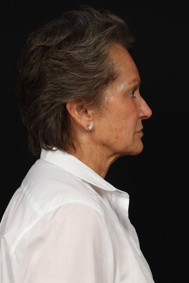 Facelift Before & After Gallery - Patient 241060 - Image 9