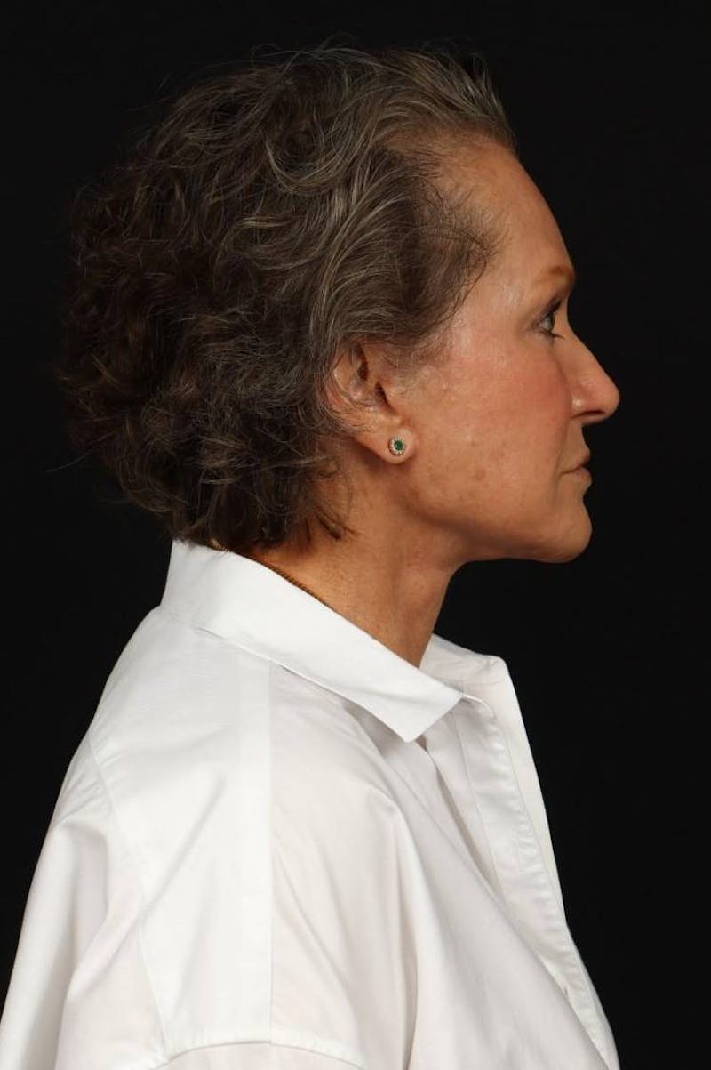 Facelift Before & After Gallery - Patient 241060 - Image 10