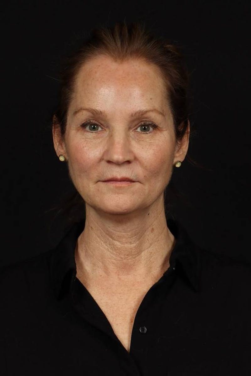 Facelift Before & After Gallery - Patient 308205 - Image 1