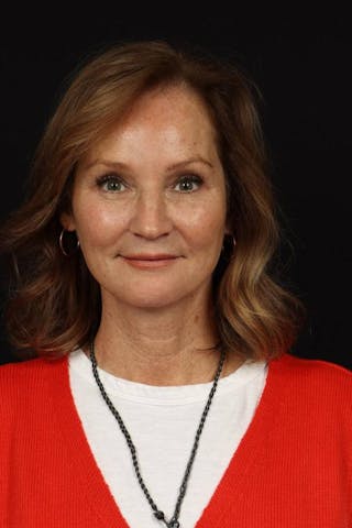 Facelift Before & After Gallery - Patient 308205 - Image 2