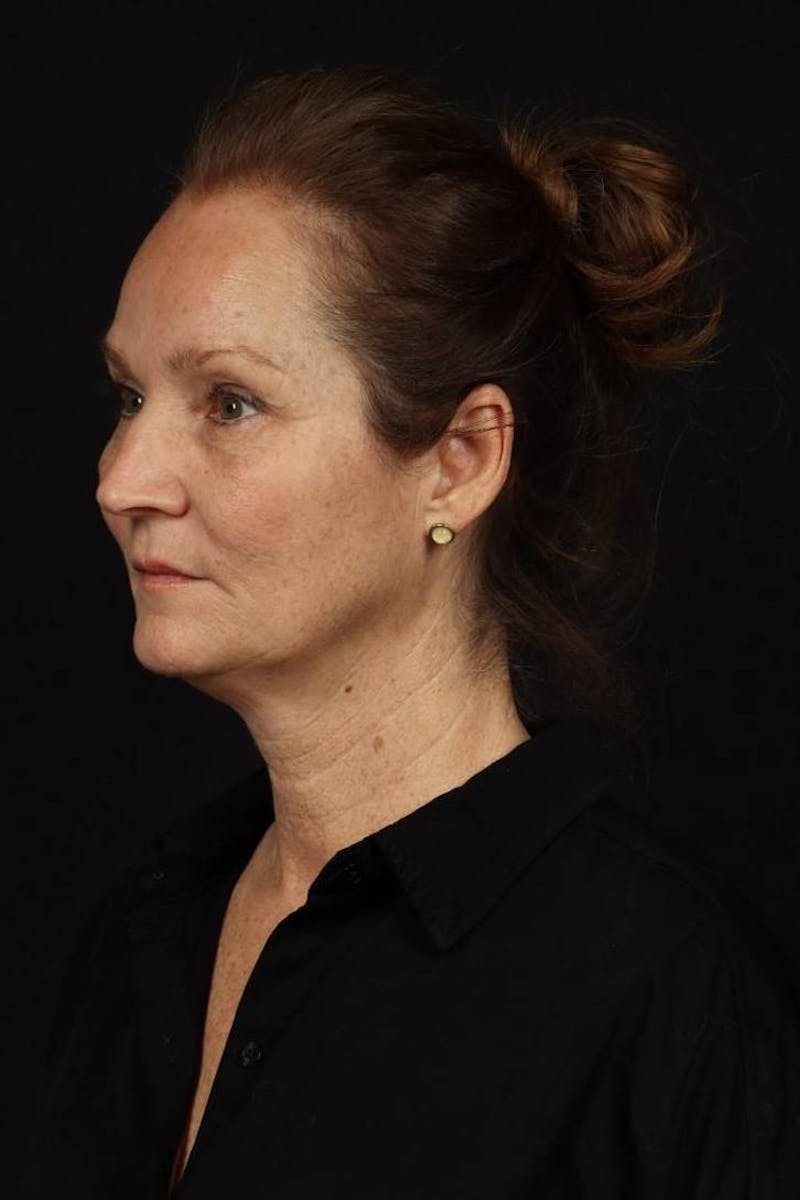 Facelift Before & After Gallery - Patient 308205 - Image 3