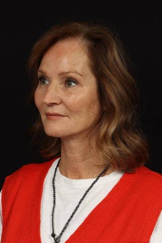 Facelift Before & After Gallery - Patient 308205 - Image 4