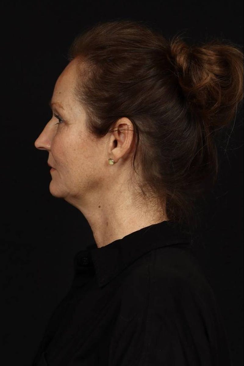 Facelift Before & After Gallery - Patient 308205 - Image 5