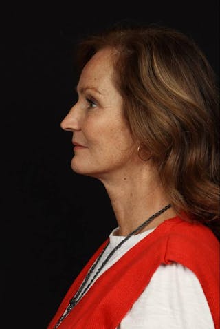 Facelift Before & After Gallery - Patient 308205 - Image 6