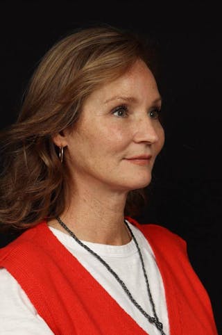 Facelift Before & After Gallery - Patient 308205 - Image 8