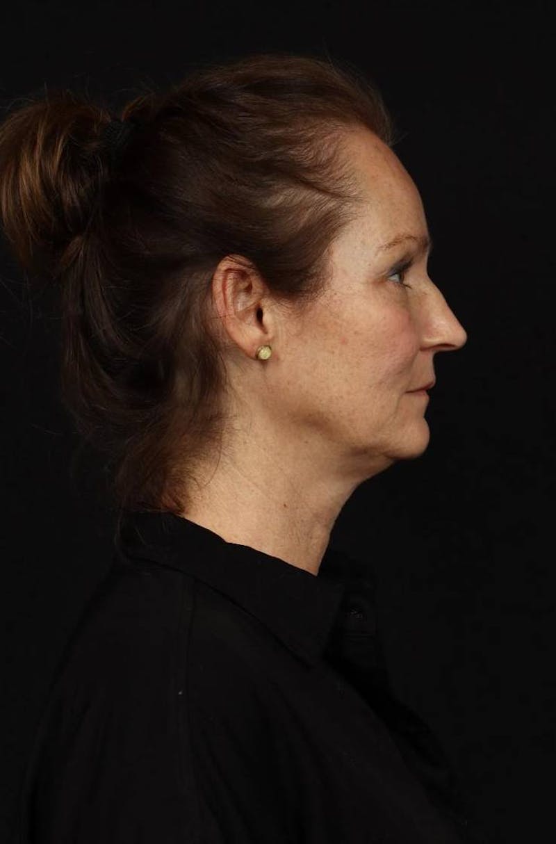Facelift Before & After Gallery - Patient 308205 - Image 9